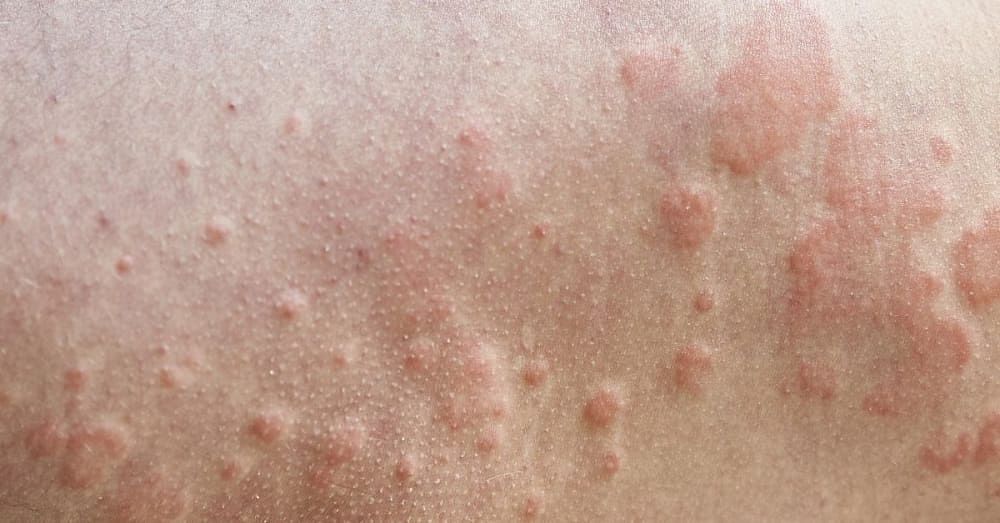 reason-s-for-red-spots-on-the-skin-in-hindi